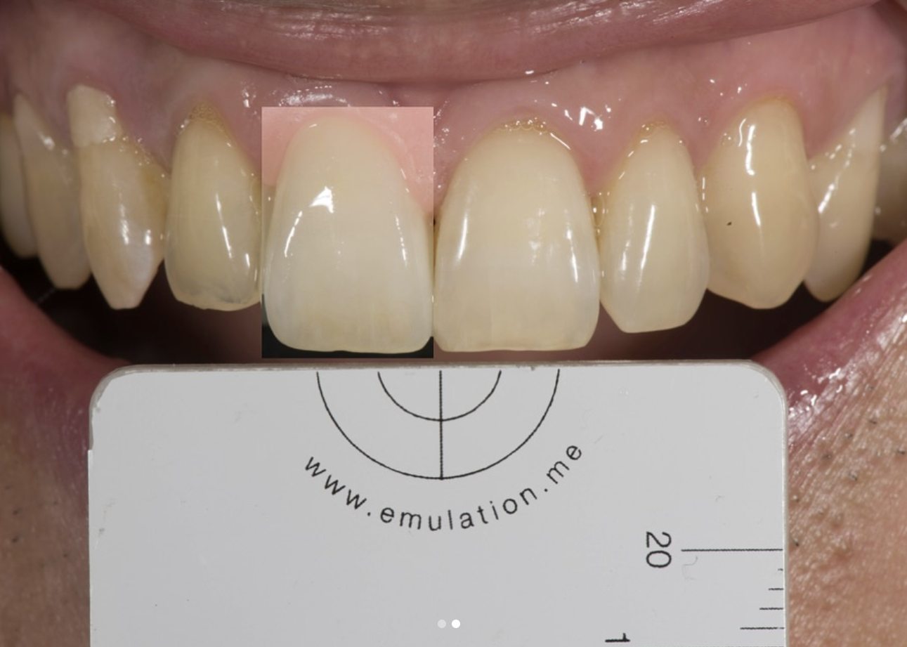 Shade Matching Case 03